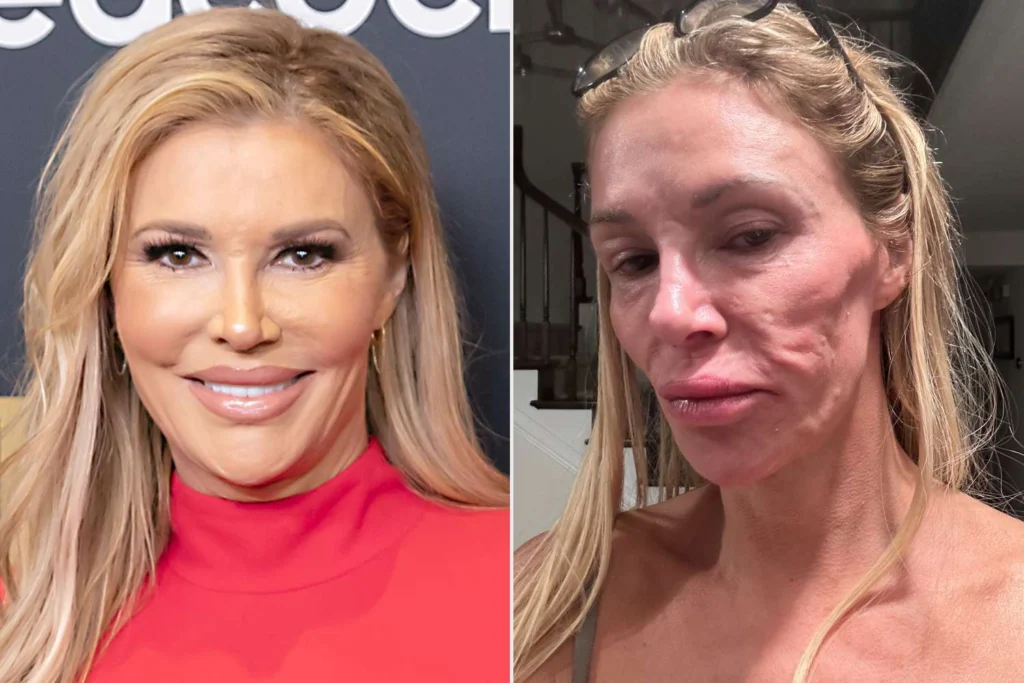 Brandi Glanville Burns Face With Nair in DIY Skincare Fail
