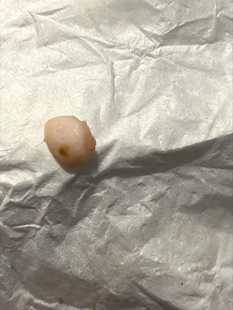 Woman Finds Human Finger in NYC Chicken Wrap — Lawsuit Filed 2 Fingertip allegedly found by Mary Elizabeth Smith