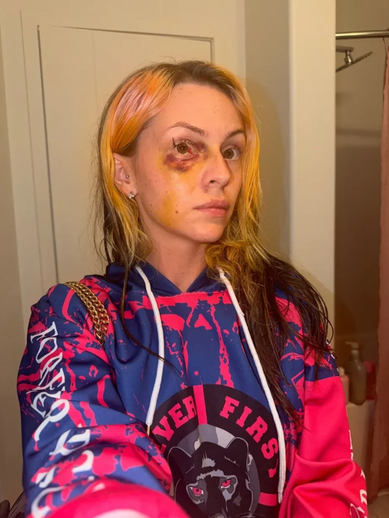 Famous Dexs Ex Shares Photos of Alleged Domestic Attack