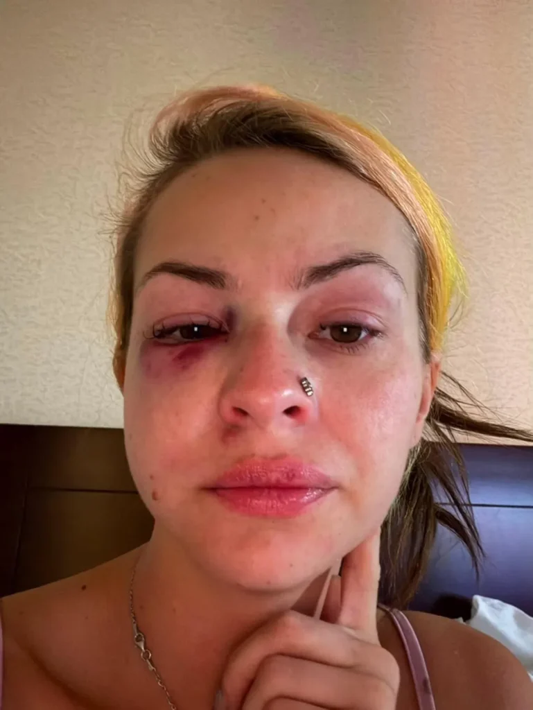 Famous Dexs Ex Shares Photos of Alleged Domestic Attack